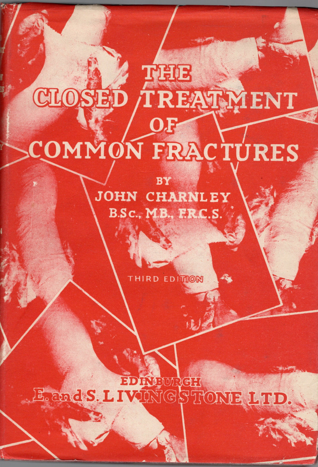 The Closed Treatment of Common Fractures